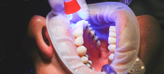 Blekning hos tandläkare