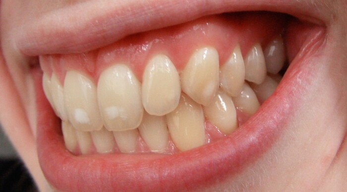 Vita fläckar på tänderna