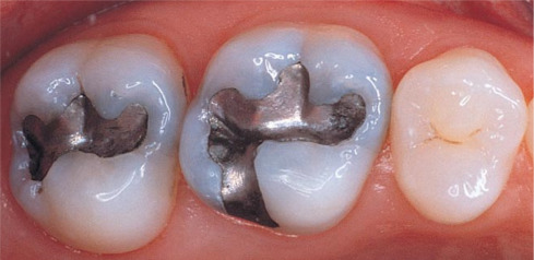 Två tänder tandamalgam