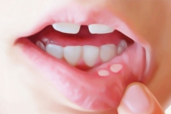 Afteblåsor i munnen