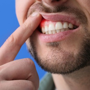 Man visar sin tandköttsinflammation